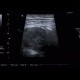 Abscess, Crohn's disease: US - Ultrasound